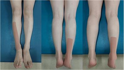 Effects of kinesio taping therapy on gait and surface electromyography in stroke patients with hemiplegia